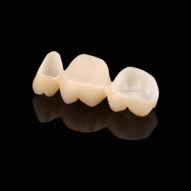 Crowns and Bridge Section 2 - TDK Dental Lab